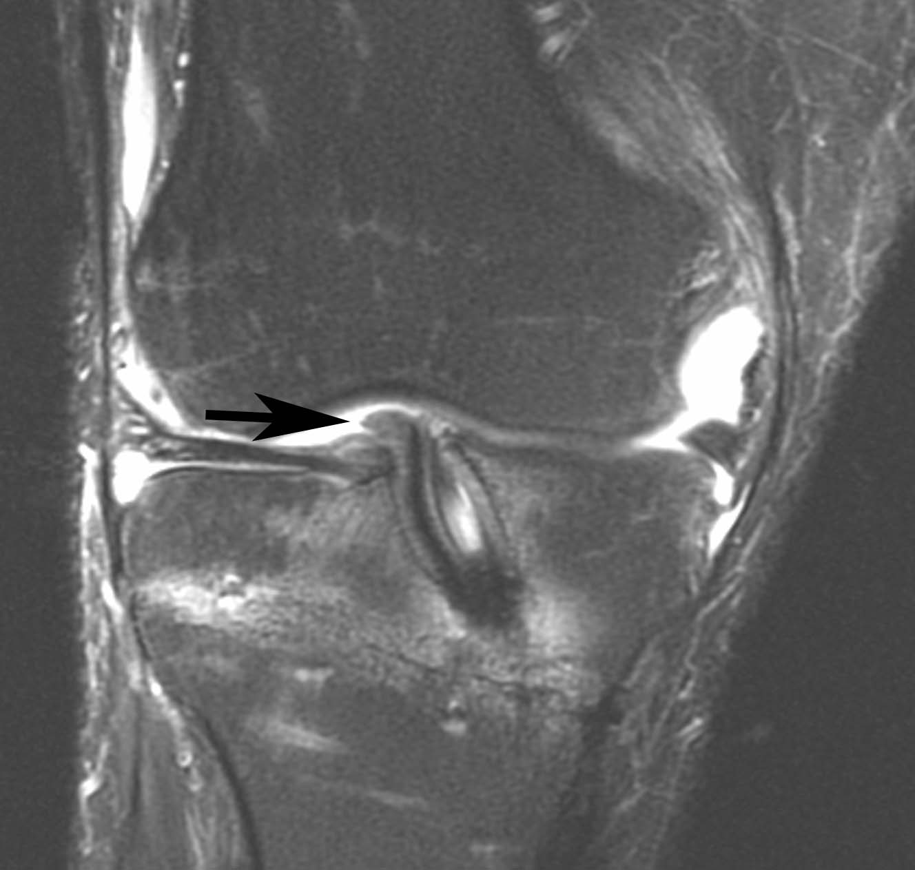 Figure 3 for case Disrupted ACL graft